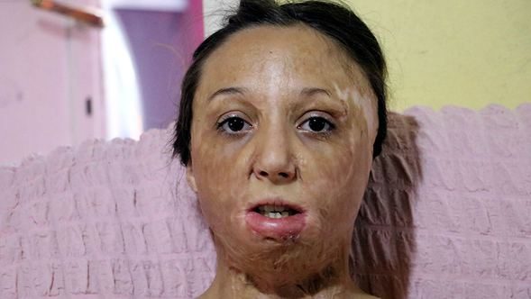  Zonguldak'ta vücudu ve yüzü yanan 13 yaşındaki yağmur yardım bekliyor 