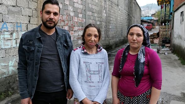  Zonguldak'ta vücudu ve yüzü yanan 13 yaşındaki yağmur yardım bekliyor 