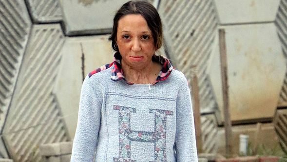  Zonguldak'ta vücudu ve yüzü yanan 13 yaşındaki yağmur yardım bekliyor 