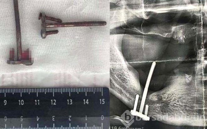 İmplant tedavisi diye gitmişti! 28 yıl sonra ortaya çıkan gerçek dehşete düşürdü