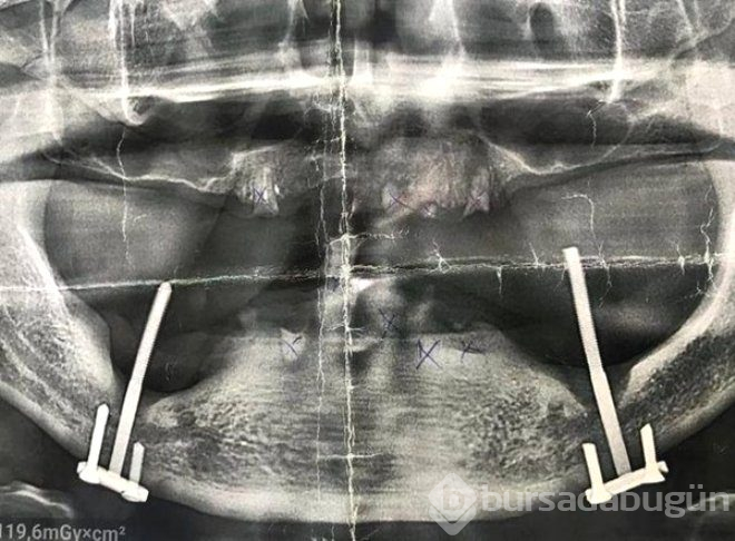İmplant tedavisi diye gitmişti! 28 yıl sonra ortaya çıkan gerçek dehşete düşürdü