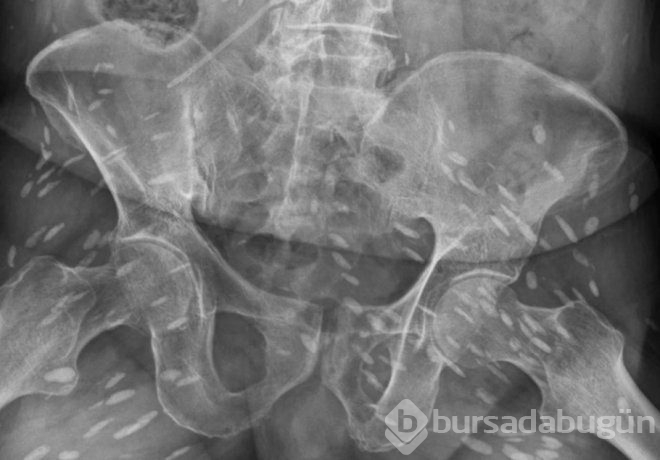 Çiğ domuz eti yiyen adamın vücudunda yüzlerce solucan yumurtası bulundu.
