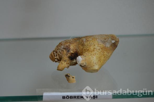  Hastalardan çıkan böbrek taşlarından sergi yaptılar 