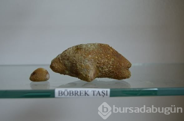  Hastalardan çıkan böbrek taşlarından sergi yaptılar 