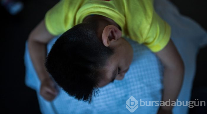 Kolombiya'da Zika Virüslü Nesil - Mikrosefali
