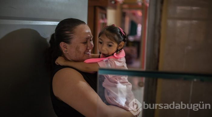 Kolombiya'da Zika Virüslü Nesil - Mikrosefali
