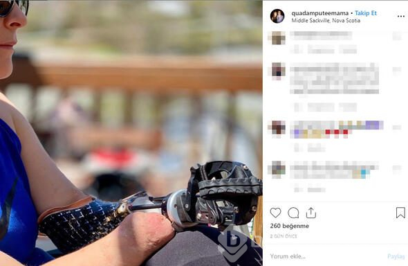 Doğum sırasında kaptığı enfeksiyon hayatını kabusa çevirdi