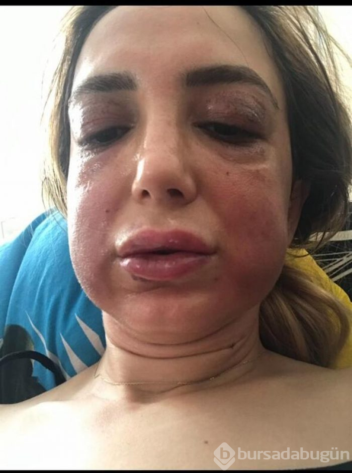 Estetik mağduru kadının yüzü tanınmaz hale geldi