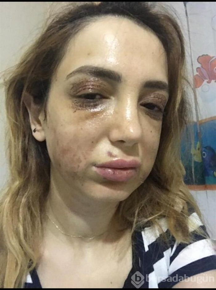 Estetik mağduru kadının yüzü tanınmaz hale geldi
