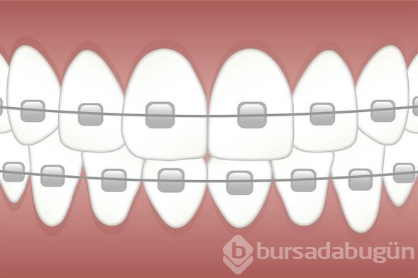 Beklemek zorunda değilsiniz! İşte tüm detaylarıyla hızlı diş teli tedavisi
