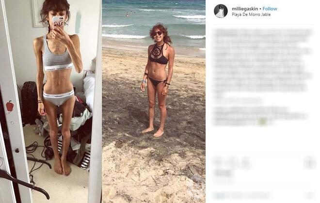 Yeni yılda zayıflama kararı aldı ve kabus başladı! 32 kilo...
