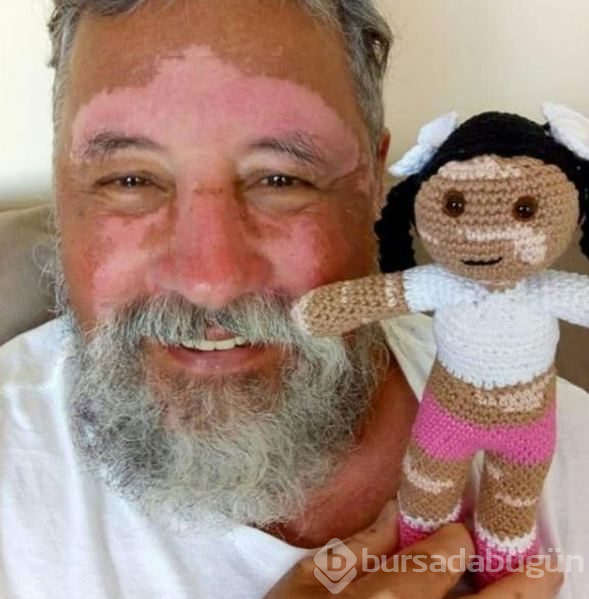 Vitiligo hastası dede torunu için bebek yaptı, ön yargıları yıktı!