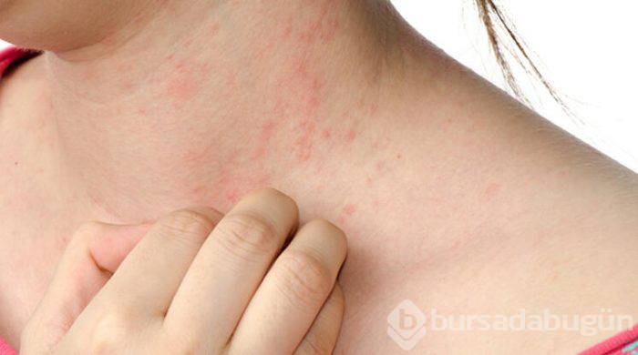 Yumurta alerjisi olanlar neden grip aşısı yaptıramaz?