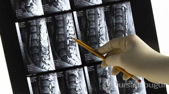 Osteoporoz hastalığına dikkat!