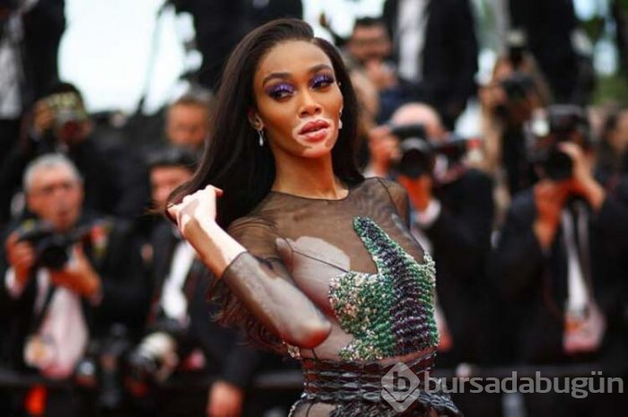 Winnie Harlow: Güzellik Algısını Baştan Yaratan Kadın!
