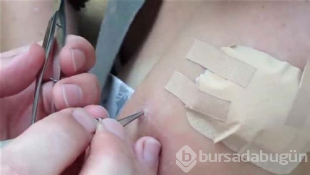 Yaranın içinden çıkanlara kimse inanamadı!