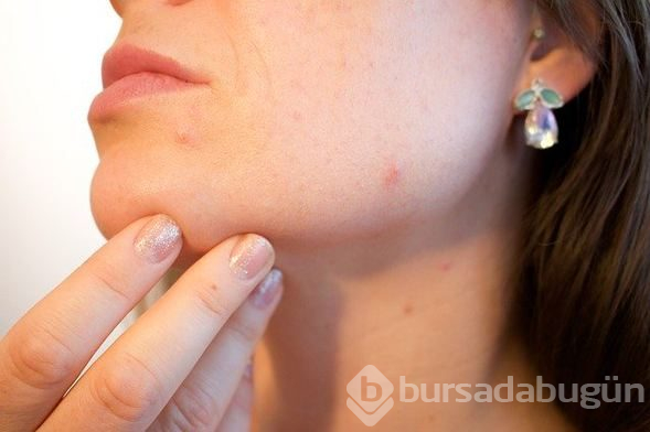 Ergenlikte sivilceye karşı 6 etkili öneri