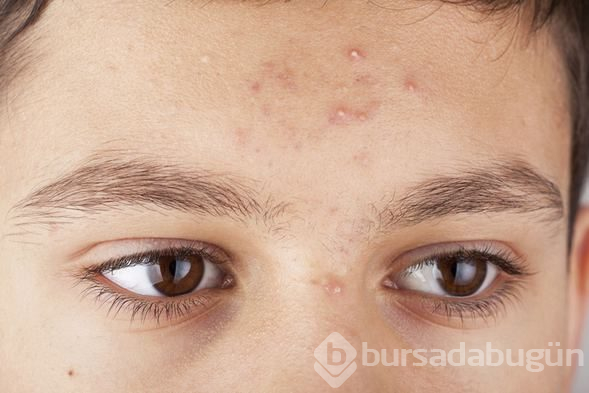 Ergenlikte sivilceye karşı 6 etkili öneri