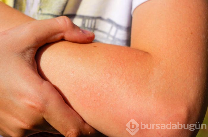 Besin alerjileri çocuklarda daha sık görülür