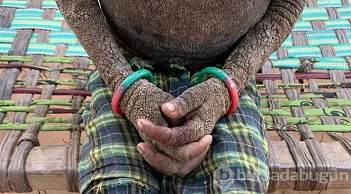 Gün geçtikçe taşlaşan kız!