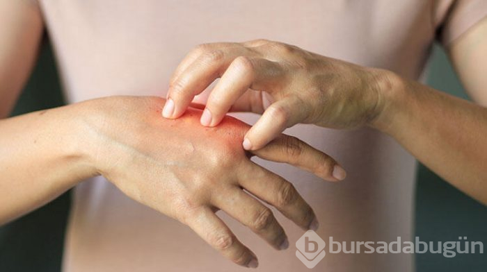 Dezenfektandan kuruyan elleri iyileştirme yöntemleri neler?