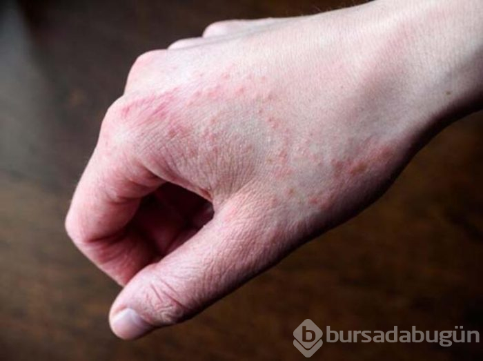 Koronavirüsten korunurken tetiklenen cilt sorunları 