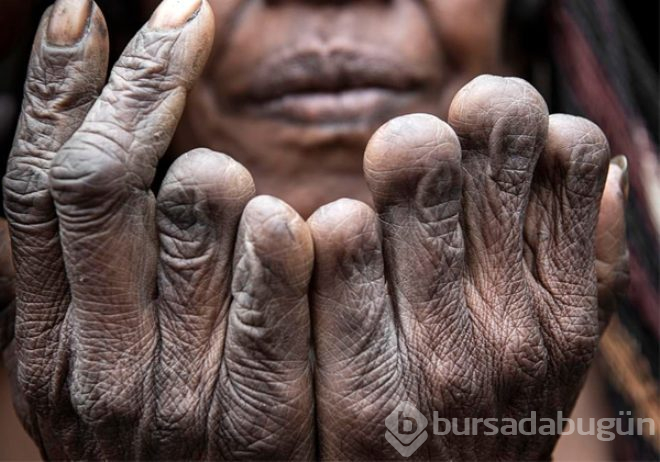 Böyle gelenek görülmedi! Sevdiği biri ölünce parmaklarını kesiyorlar