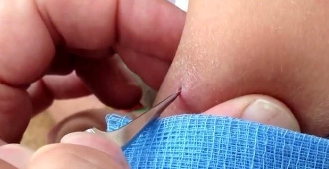 Genç kadının kolundan botfly cinsi sineğin larvaları çıktı!