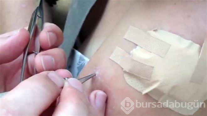 Genç kadının kolundan botfly cinsi sineğin larvaları çıktı!