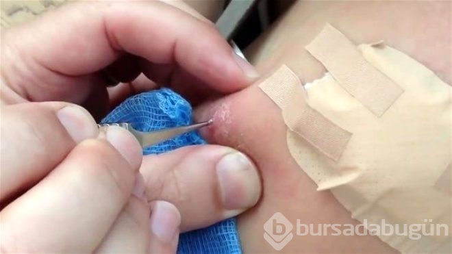 Genç kadının kolundan botfly cinsi sineğin larvaları çıktı!