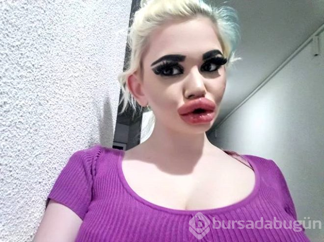Dudağına 20'den fazla dolgu yaptırdı!