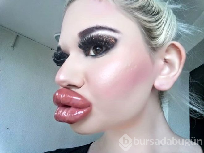 Dudağına 20'den fazla dolgu yaptırdı!