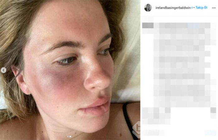 Ireland Baldwin darbedildikten sonra ilk kez görüntülendi
