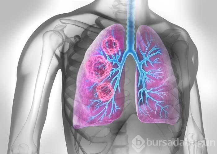 Akciğer kanserinin 4 kritik belirtisi!