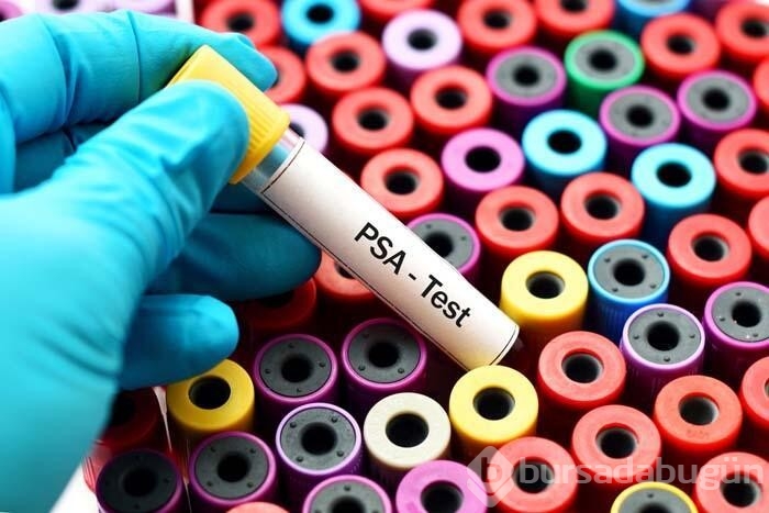 Prostat kanseri biyopsi olmadan tespit edilecek...