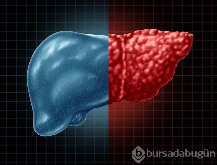Karaciğerdeki bu yağlanma organ nakline götürebilir