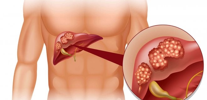 Karaciğerdeki bu yağlanma organ nakline götürebilir