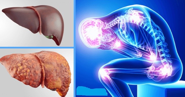 Karaciğerdeki bu yağlanma organ nakline götürebilir