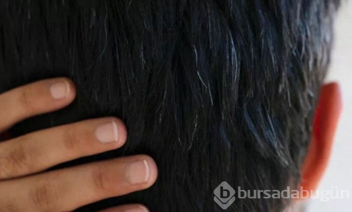 Erken yaşta saç beyazlatan nedenler ve alınacak önlemler