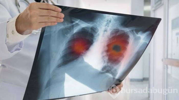 Sigara içiyorsanız kanser riski 20 kat artıyor!