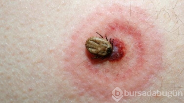 Lyme hastalığı nedir? Nelere dikkat edilmelidir?
