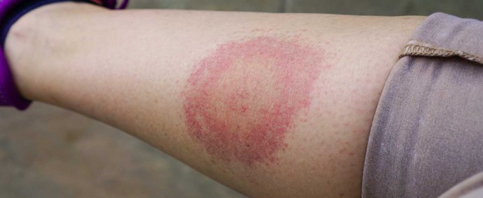 Lyme hastalığı nedir? Nelere dikkat edilmelidir?
