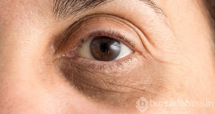 Göz altı morluklarına iyi gelen doğal çözüm önerileri