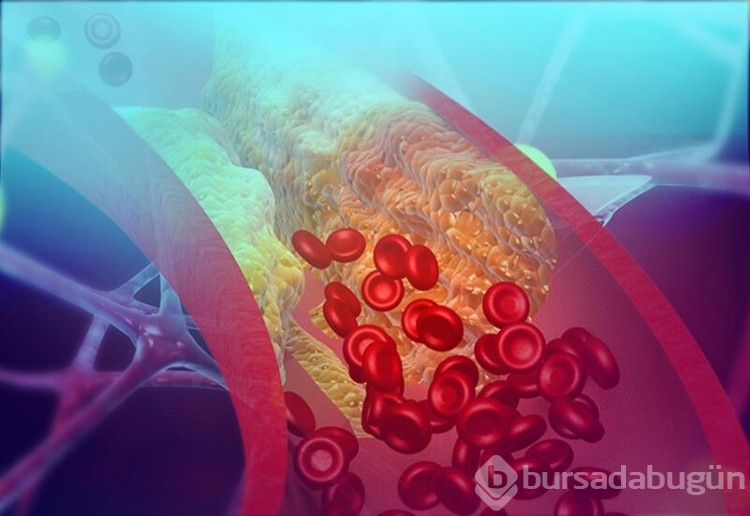 Kolesterolün ilk belirtisi parmaklarda ortaya çıkıyor!
