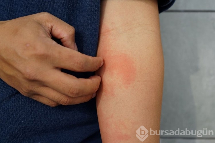 Alerji ve astım kalp hastalığı yaşama riskini artırıyor