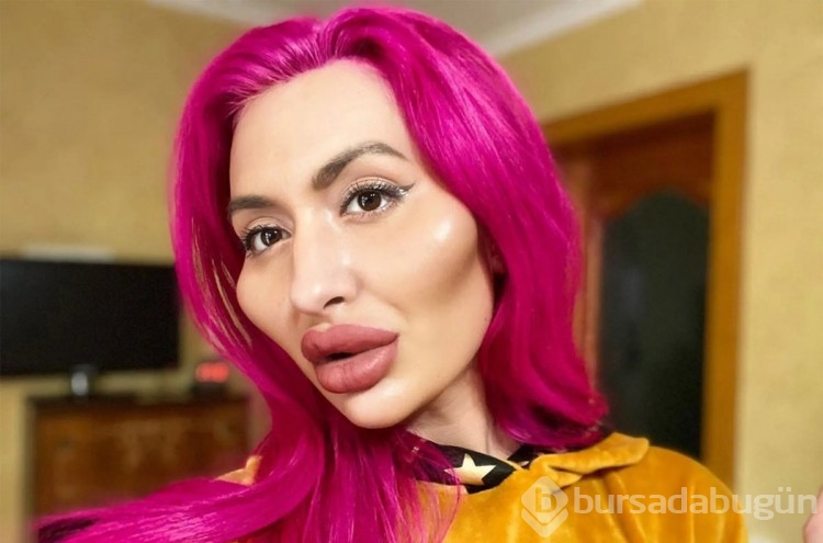 Dünyanın en büyük yanaklı kadınına bir dolgu daha