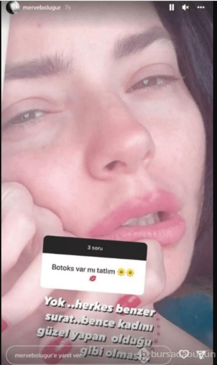 Merve Boluğur'dan dikkat çeken botoks cevabı