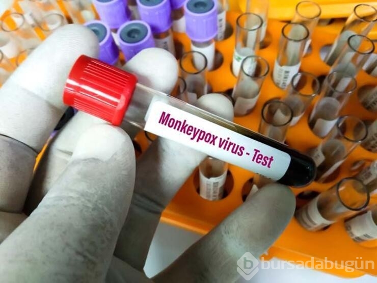 Maymun Çiçeği virüsü ile ilgili kritik uyarı!