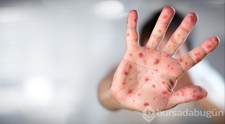İngiliz bilim insanlarından uyarı: Maymun çiçeği salgını 10 kat büyüyebilir