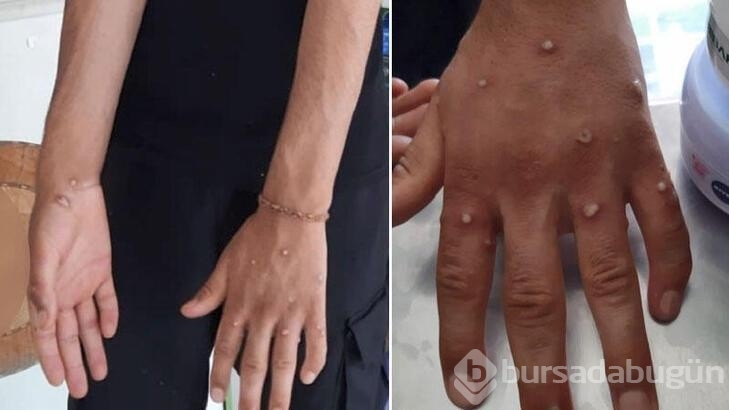 Maymun çiçeği virüsünün belirtileri nelerdir? Maymun çiçeği nasıl bulaşır?
